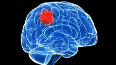 این 8 نشانه تومور مغزی را نادیده نگیرید